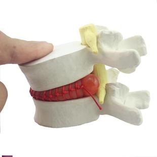 ENOVO颐诺医学人体腰椎间盘突出演示模型脊神经模型骨科脊柱椎间