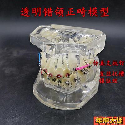 牙科正畸模型 透明错颌矫正展示模型 结扎丝托槽正畸带支抗钉牙列