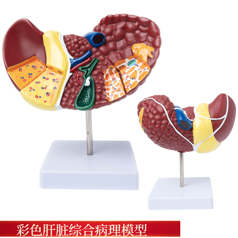 彩色肝脏模型常见临床病理特征医生用医患L沟通硬化脂肪炎肝胆内