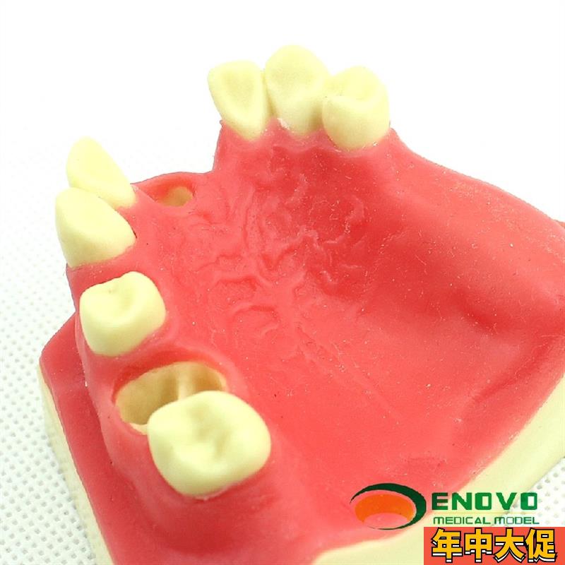 ENOVO颐诺口腔即刻种植练习操作模型上颌骨上颌窦牙列缺失种植体
