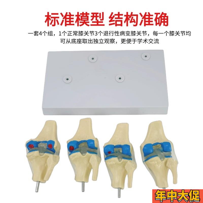 人体四阶段病理膝关节骨骼结构解剖模型病态膝盖骨质教学骨科展示