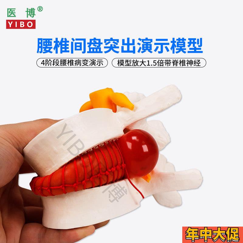 医博BIX-A3561人体腰椎间盘突出病变演示模型人体脊柱腰椎模型 人