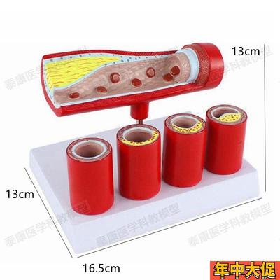 动脉血管模型内膜粥样斑块阻塞狭窄硬化医患药礼品血管壁层次解剖