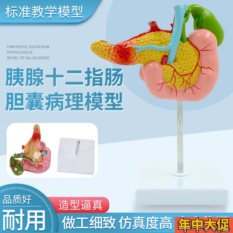 医学胰腺十二指肠胆囊病理模型 胆结石外科消系统肝胆科模型