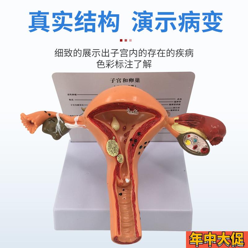 人体女性生殖子宫解剖病理模型阴道卵巢教学模型妇科生殖科教模型