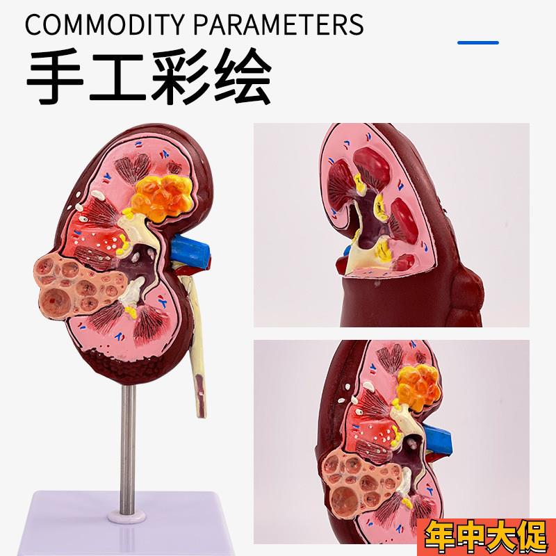 人体肾解剖模型,病理肾脏模型 正常肾部模型专业内脏器官医学教具