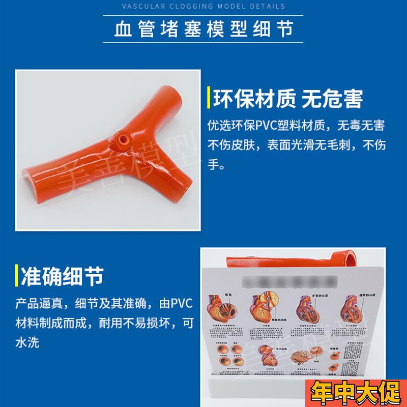 血管堵塞动支脉粥样硬化心血管模型 堵塞程度变化 病理血管模型
