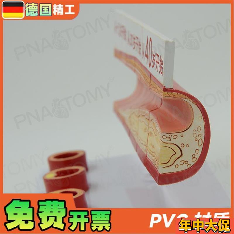 德国】人体动脉血管堵塞模型心脑血管血栓/硬化模型 教学心脑血管