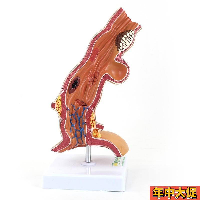 ENOVO颐诺 人体食管疾病理模型
