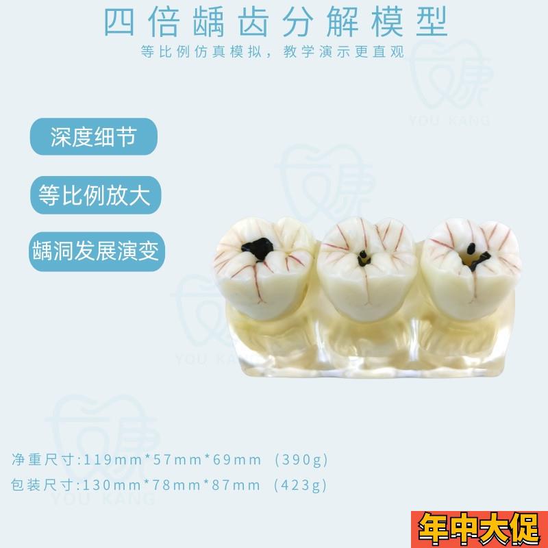 牙模型牙科口腔教学模型窝沟封闭模型龋齿对比模型龋齿模型