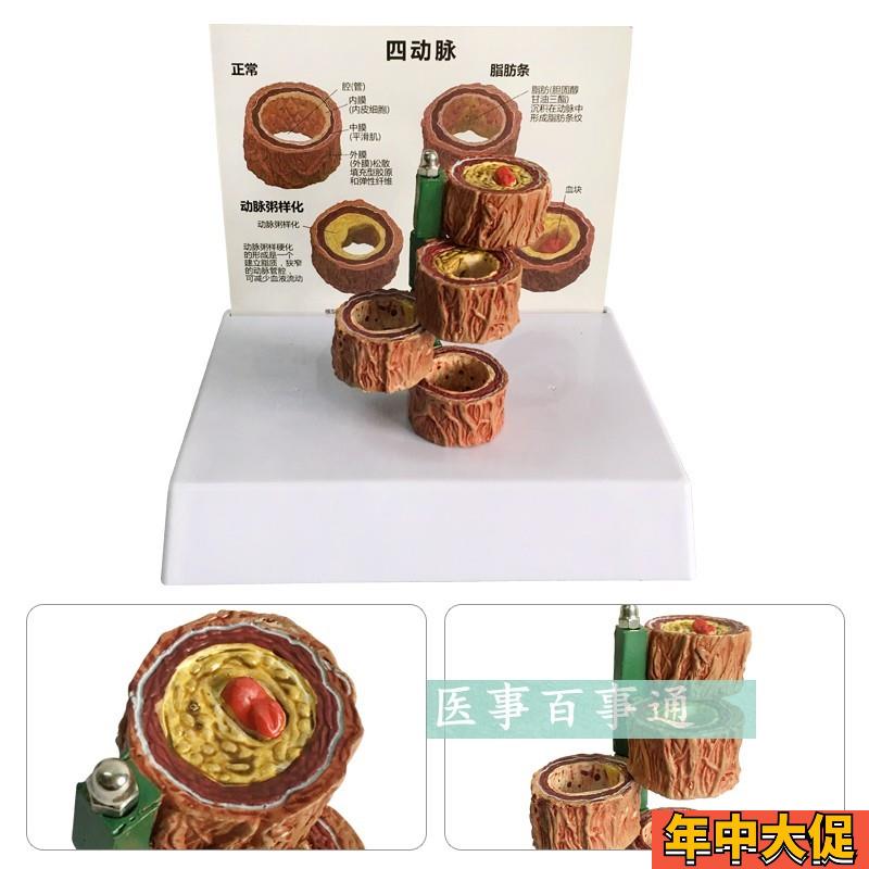 动脉11化模型带血栓模型 血管模型 形成过程模型 人体粥样化