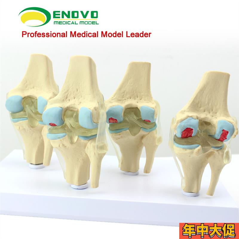 ENOVO颐诺人体病理膝关节模型 退行性血友病模型骨科管骨骼模型膝