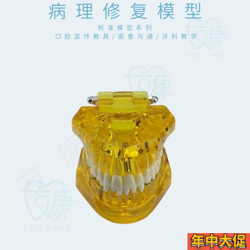 牙齿模型病理修复可拆卸正畸口腔病理牙模型牙科医患活动沟通