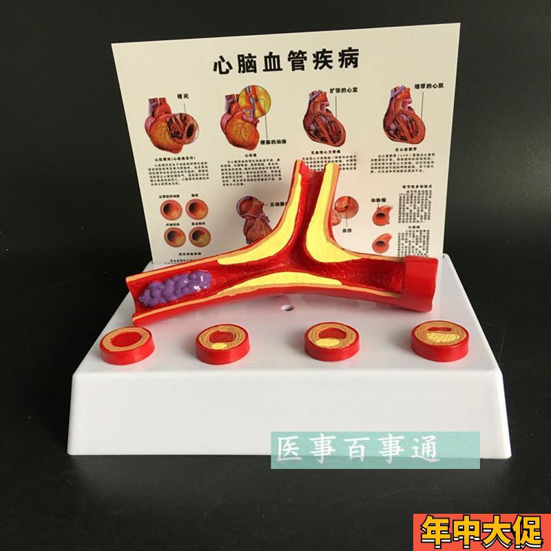 血管模型冠状动脉性心脏病 动脉 化模型 老年科医患沟通演示模型