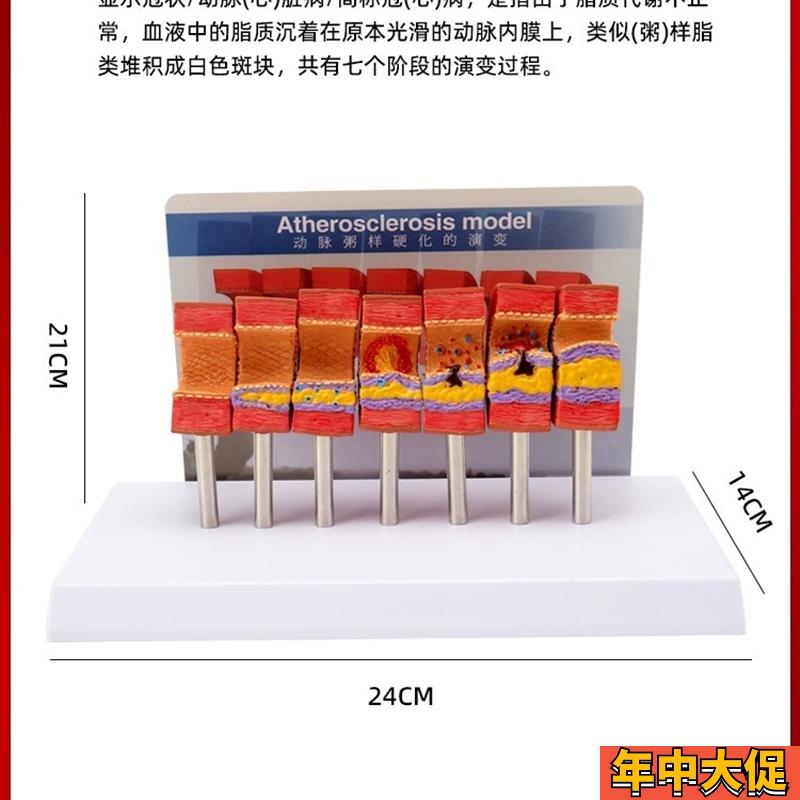 心脑血管堵塞动支脉粥样硬化血栓血液浓度脂肪病理教学用模型道具