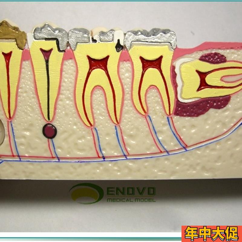 ENOVO颐诺 右下后牙组织分解模型牙齿解剖牙列模型口腔齿科科教学