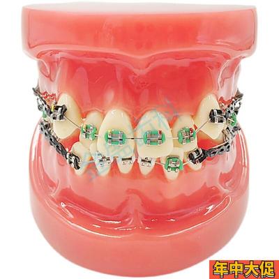 齿科口腔教学模型 半金属半陶瓷托槽正畸模型 错颌矫正正畸模型