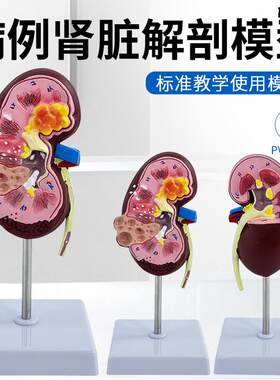 专业肾脏病变模型泌尿科肾模型d肾脏解剖模型病理与正常肾解剖