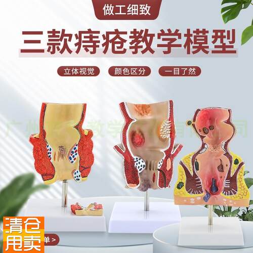 痔疮直肠病理模型溃杨性结肠病肠直肠解L剖病理模型病态疾病教具