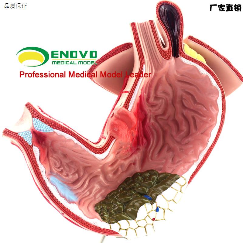 颐诺正品医用J胃部疾病演示模型人体胃解剖消化系统模型消化科