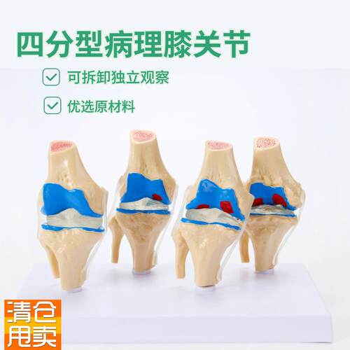 人体病理膝关节模型病变四分型膝关节退行性膝关节UV关节镜手术沟