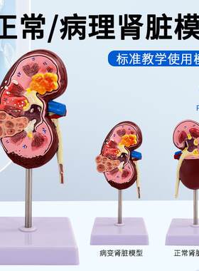 人体病变肾上腺模型肾I脏解剖模型肾模型生殖泌尿科肾病理模型