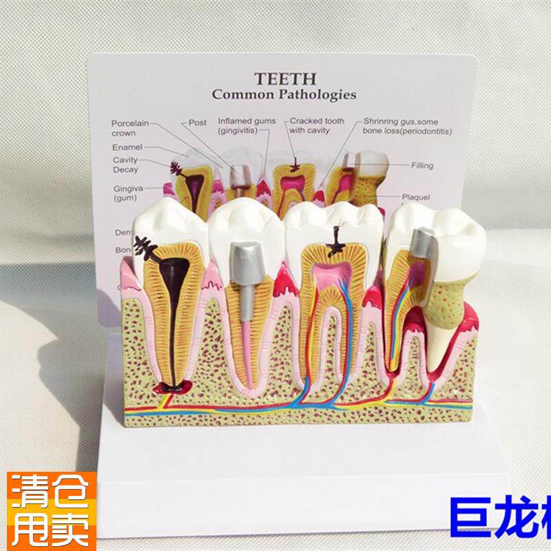 正品牙齿常见h病组合模型人体模型内脏口腔医学教具蛀牙牙齿