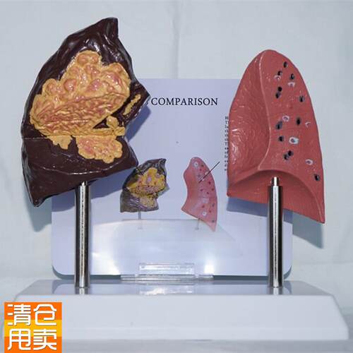 吸烟肺与正常肺比较模型人体病理展示Q医用教学讲解教具