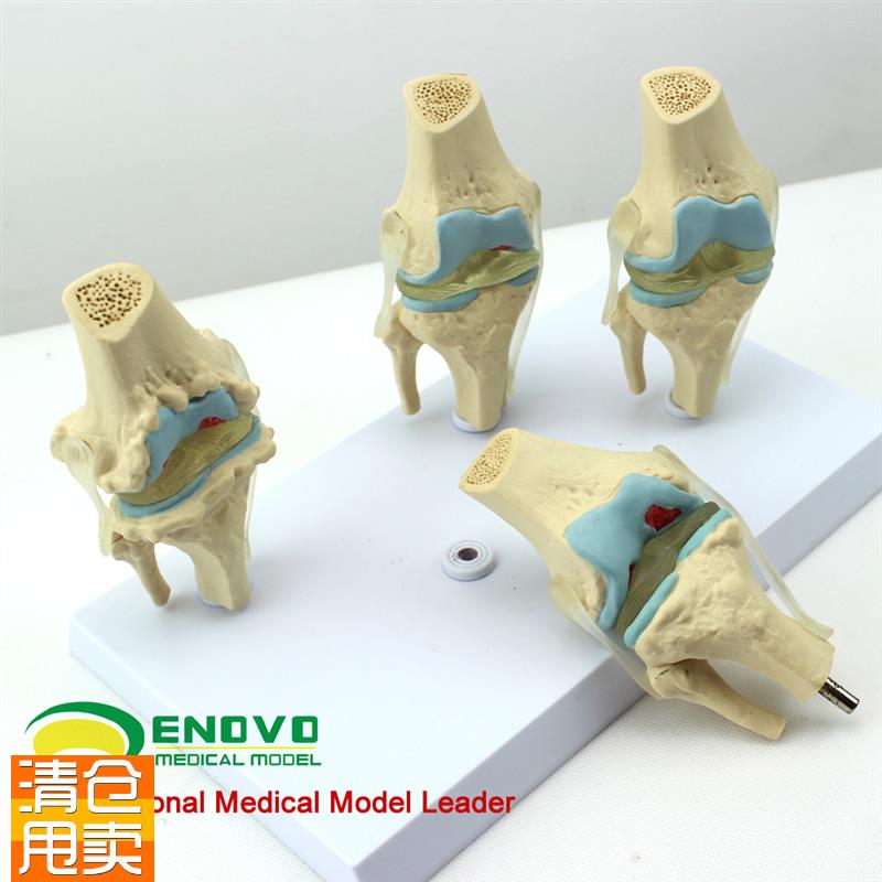 颐诺正品人体病理膝关节模u型血友病退行性膝关节病发炎膝关节模