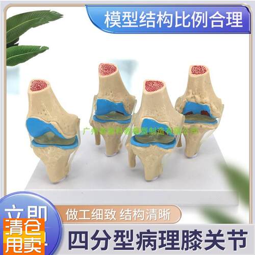 病变膝关节模型退行性关节人体膝关节功能模型半月板交叉韧带髌
