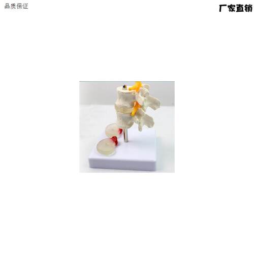 人体腰椎骨骼模型病变A椎间盘模型腰椎骨病变模型