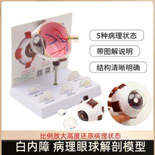 白内障眼球病变模m型青光眼眼球结构模型医患教学解剖展示模型