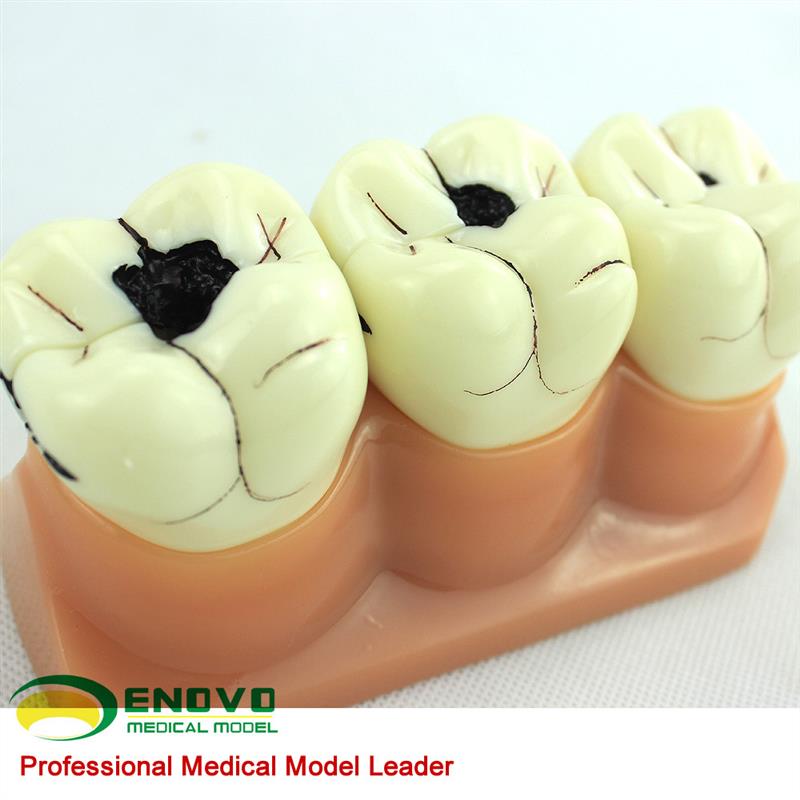 ENOVO颐诺口腔科牙齿龋齿模型儿童虫牙蛀牙P模型口腔健康儿童病理