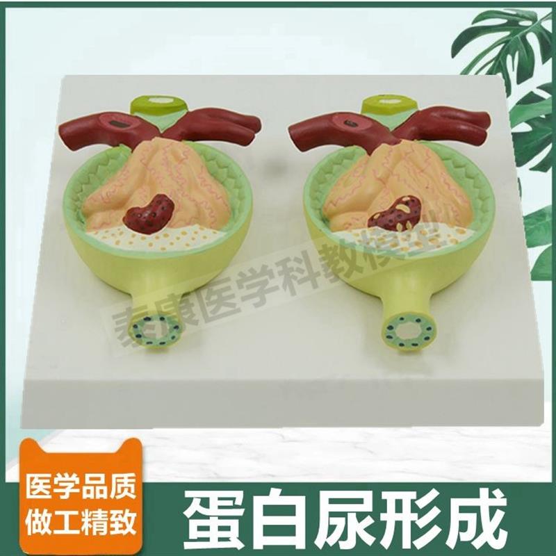 尿蛋白模b型病理肾脏肾小球肾单位肾上腺病肾泌尿器官内分泌医患