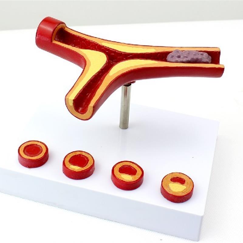 ENOVO颐诺冠状动脉性心血管z动脉硬化模型老年心脏模型血栓心内科