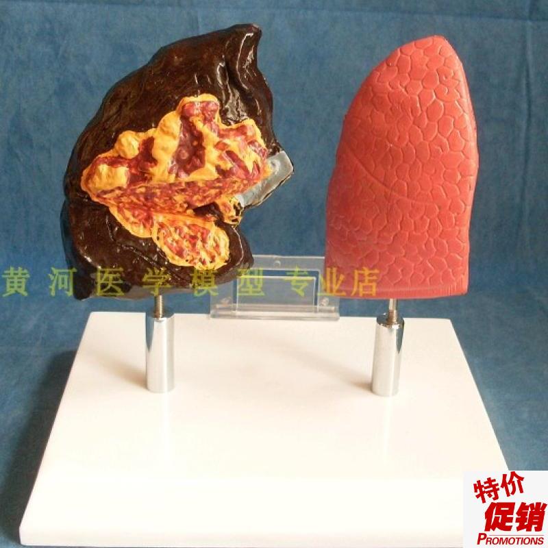 人体内脏健康肺和病态肺比较A模型病态肺模型病理肺解剖模型