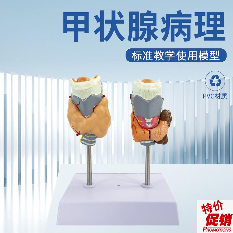 教学仿真人体甲状m腺病理模型甲亢模型病态甲状腺模型甲状腺结节
