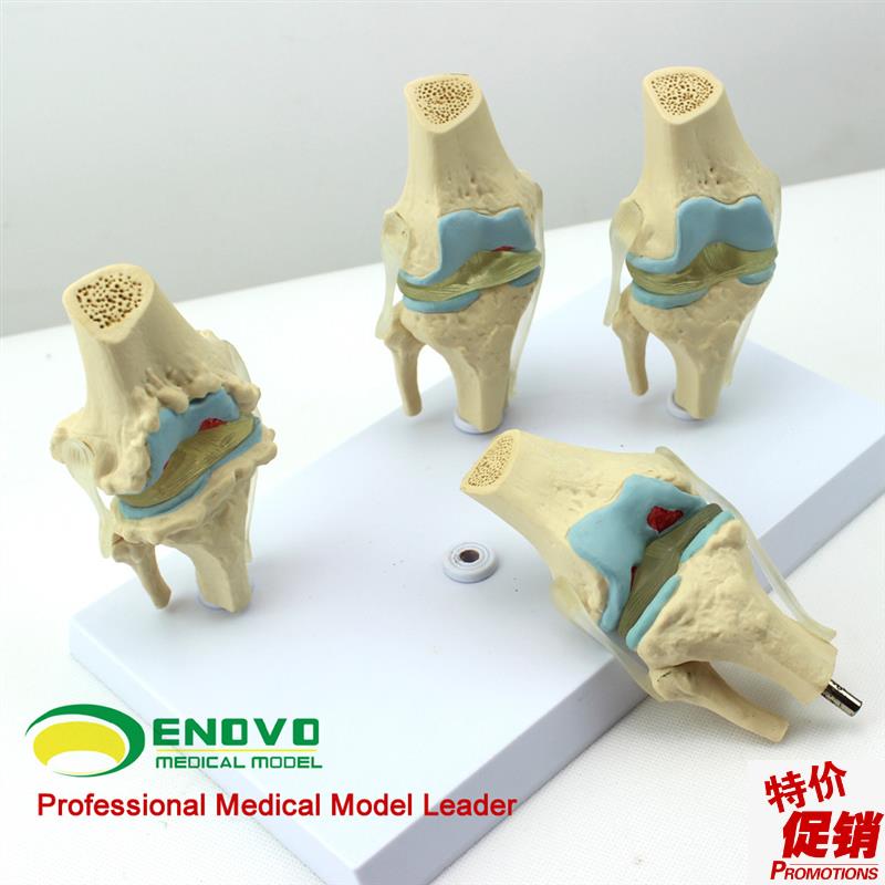 颐诺正品人体病理膝关节模型血A友病退行性膝关节病发炎膝关节模