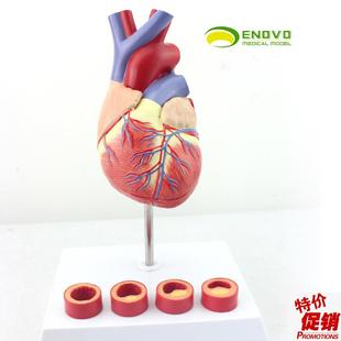 ENOVO颐f诺1:1医学人体心脏模型冠状动脉血栓心内科教学动脉粥样