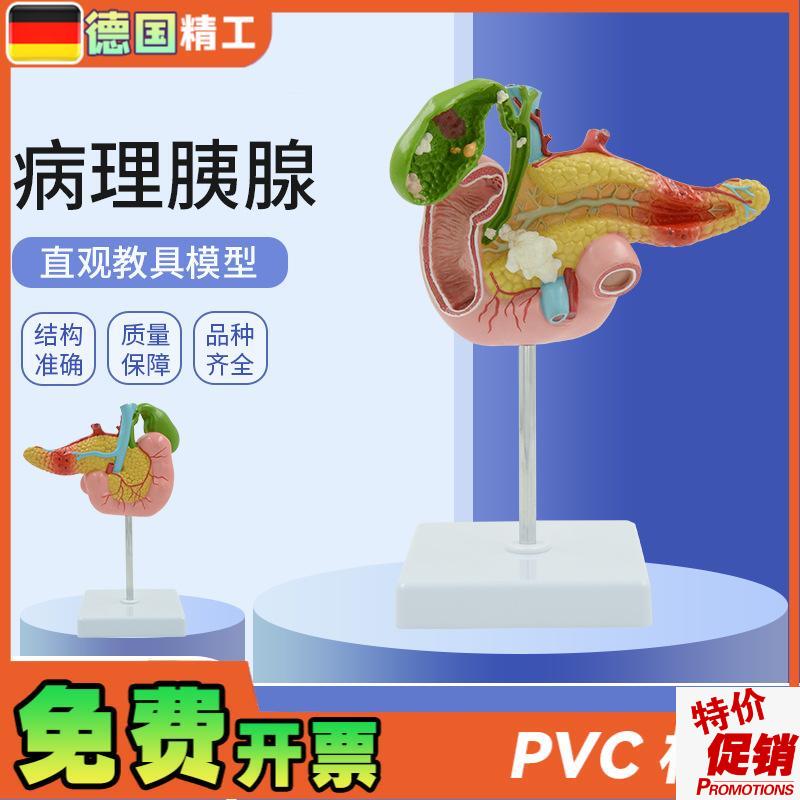 德国】教学仿真病变胰脾肝胆十C二指肠模型病理胰腺标本胰脾肝