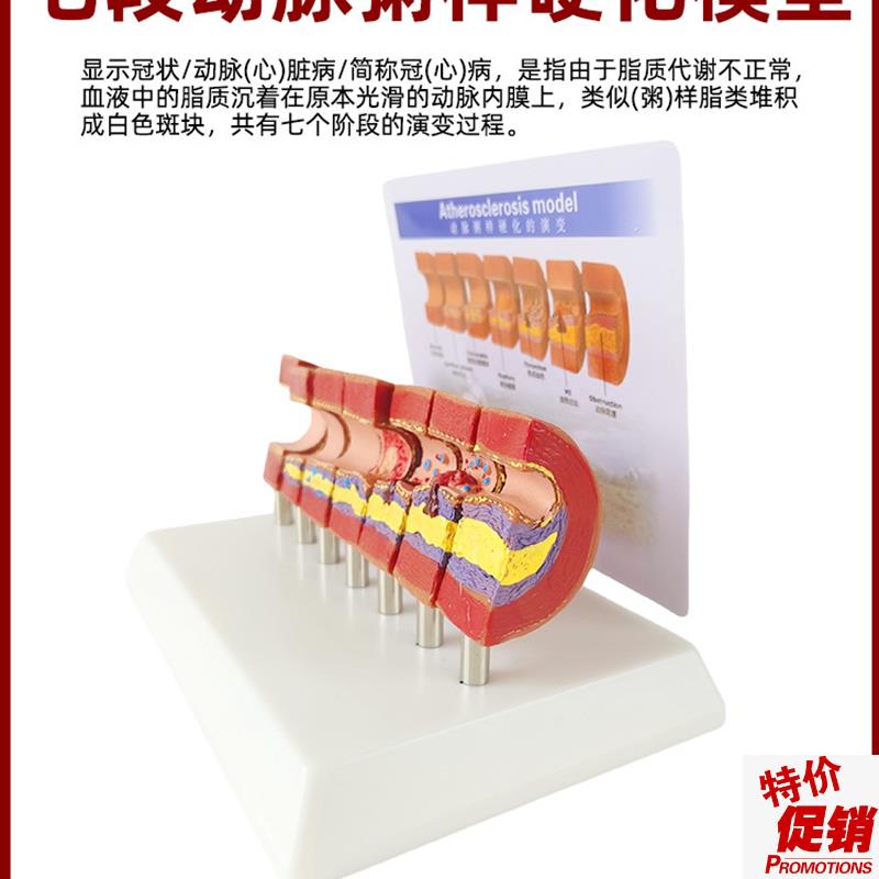人体心脑血管动脉粥样硬化堵塞模型血栓K血液脂肪病理解剖医学教