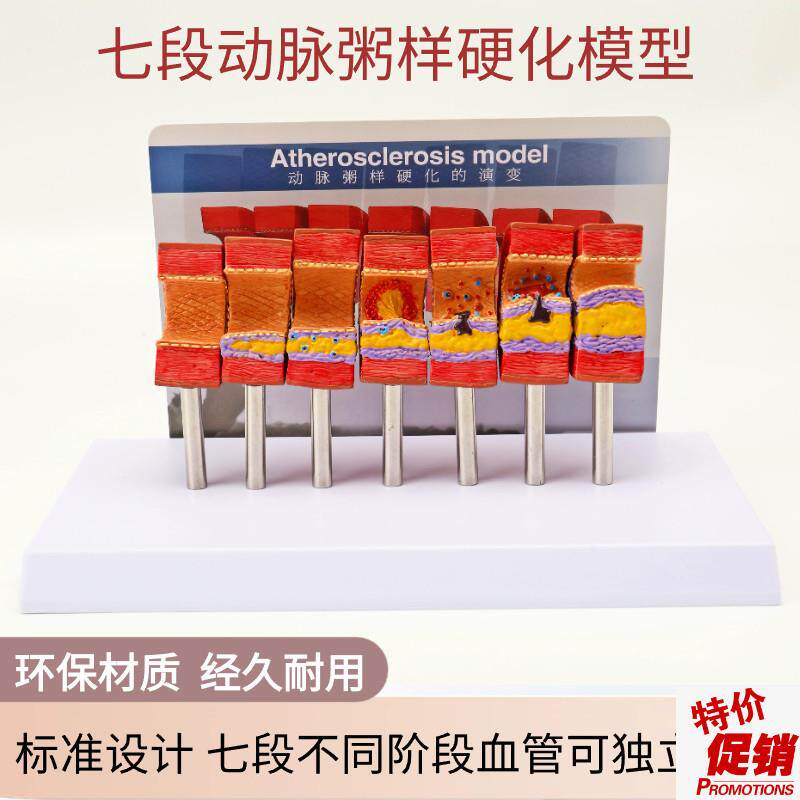 动脉粥样硬化模型血m管血栓栓塞模型动脉血管人体医用医学教学模