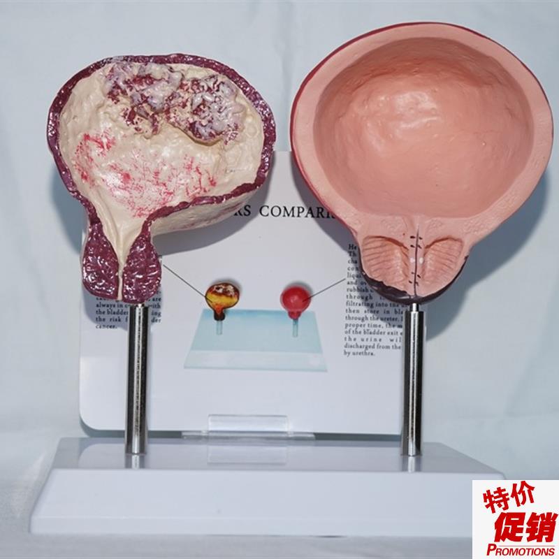 吸烟膀胱与正常膀胱比较y模型医用教学健康讲解展示