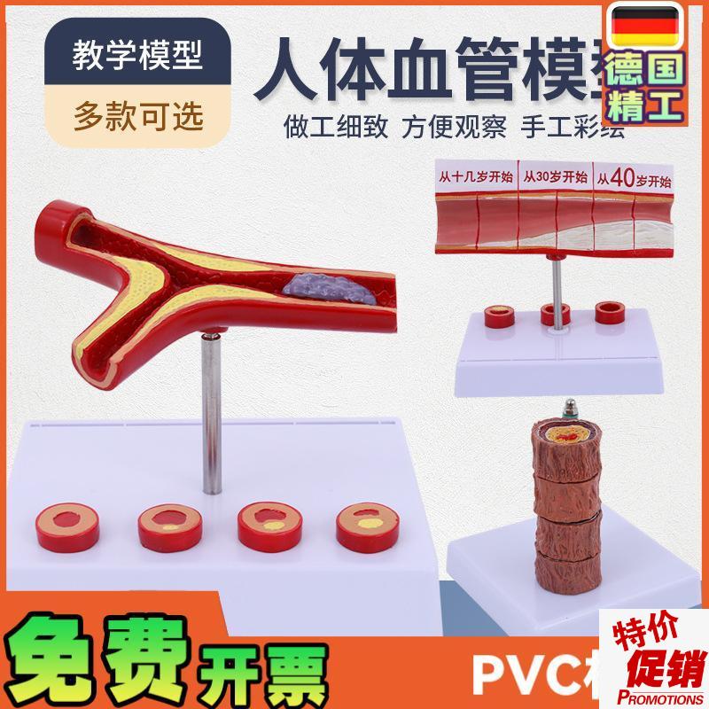 堵塞心血管模型血栓血液浓度脂肪病理粥样硬Q化人体血管解剖模具