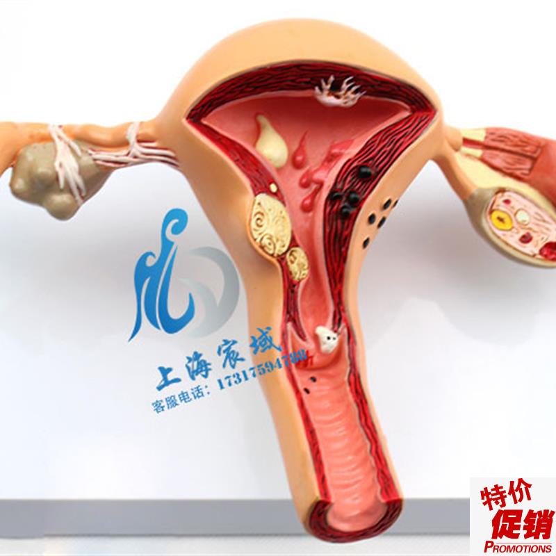 子宫卵巢病理病变模型生殖科女性内I外生殖器官模具教学病变