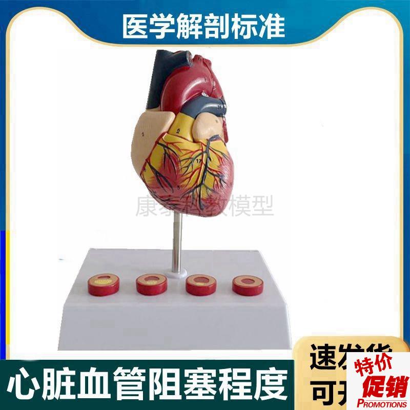心血管模型冠h状动脉粥样阻塞硬化程度狭窄脂肪斑块内膜栓子医患