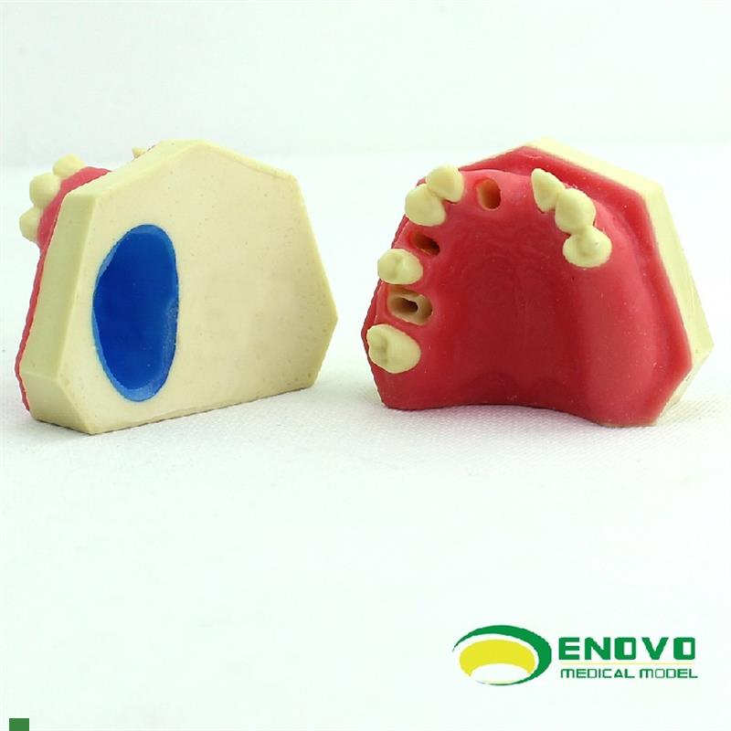 ENOVO颐诺口腔即刻种植练习操作C模型上颌骨上颌窦牙列缺失种植体
