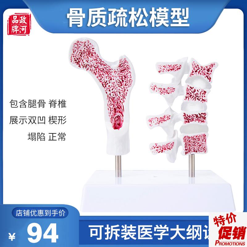 骨质疏松模型人体骨o骼教学模型股骨头脊椎双凹塌陷楔形病理病变