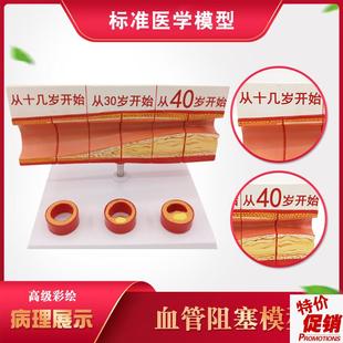 人体血管模型动脉血n管阻塞变化演示教学模型器官解剖结构层次模