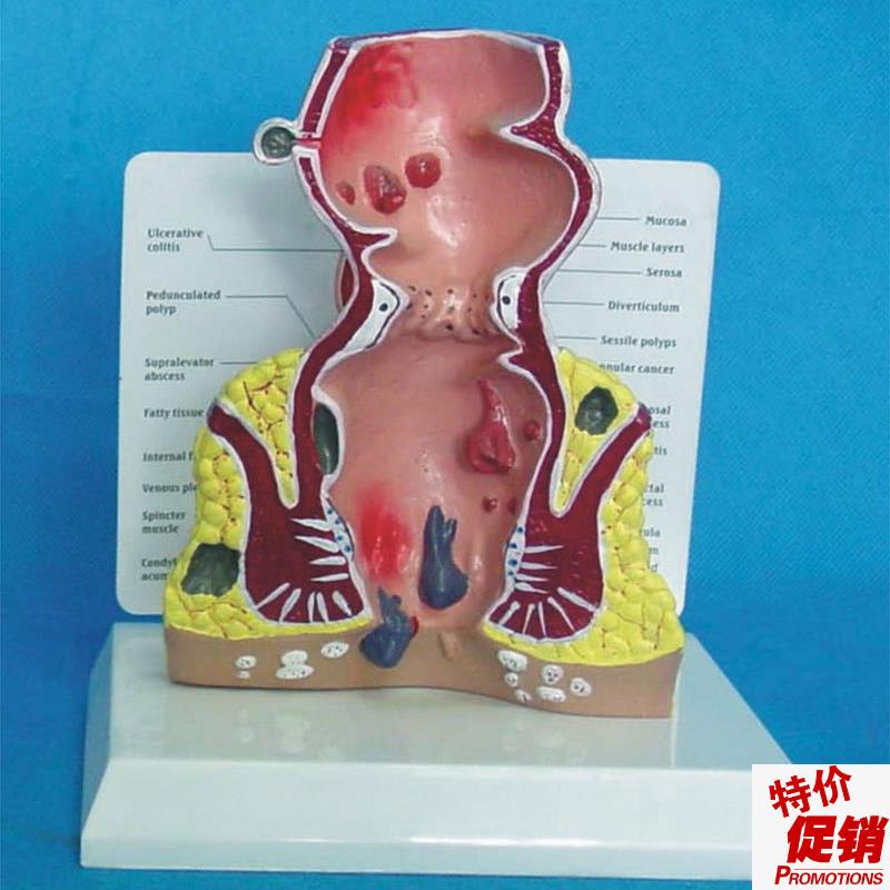 直肠解剖模型病态直肠肛门模型/痔/疮G/内/痔/外/痔教具包邮优惠